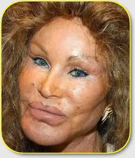 botox-woman.webp