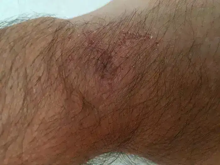 Muñeca alergia.webp