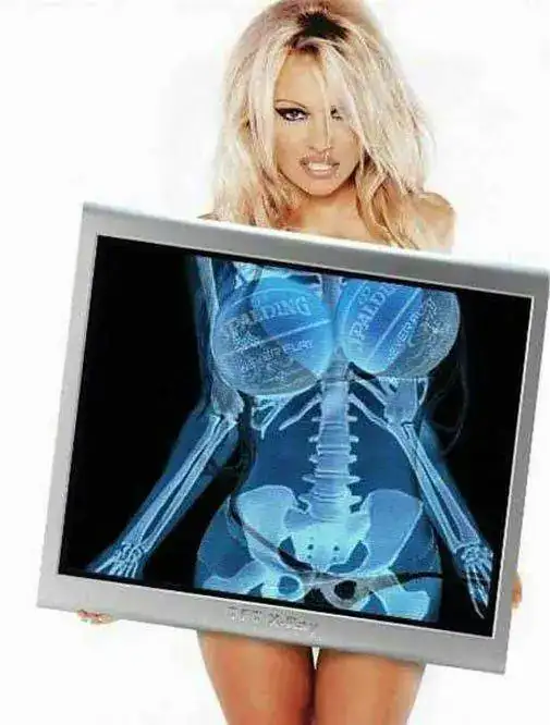 Pam_Anderson_s_X-ray.webp